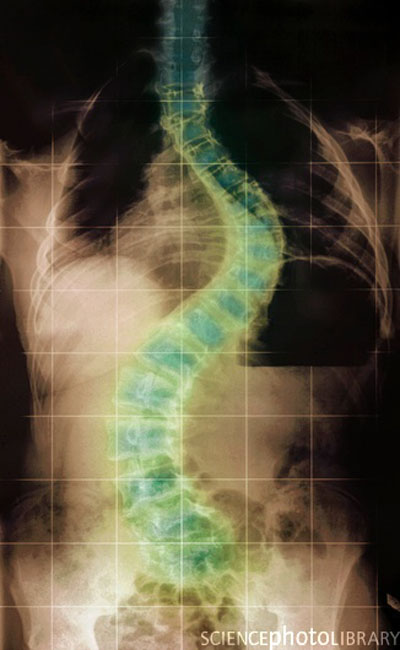 Soto_Syndrome (5).jpg